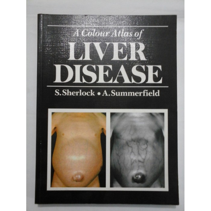 A COLOUR ATLAS OF LIVER DISEASE (Atlas color boli de ficat) - SHERLOCK / SUMMERFIELD